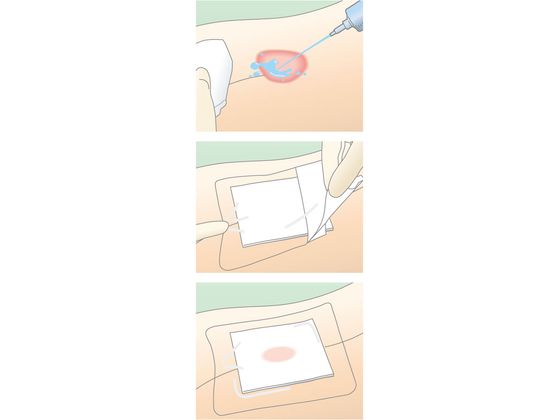 デルマエイド　２箱 デルマエイド [アルケア] 2号(50×75mm）の通販 | Ciモール医療